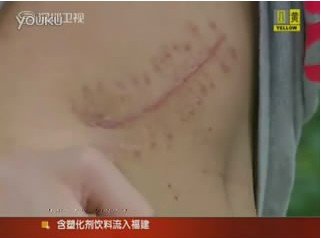 17歲高中生為買iPad2 2萬元賣掉自己右腎